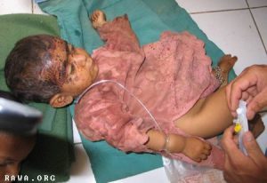 Giugno 2007. Bambina ferita nel bombardamento ISAF di Grishk. Fonte: RAWA/Middle East Times.